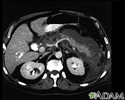 Pancreatite, aguda - tomografia computadorizada
