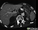 metástase adrenal, tomografia computadorizada