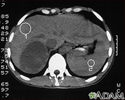 Tumor Adrenal - tomografia computadorizada