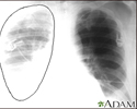 Rompimento da aorta, radiografia do tórax