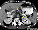 Pancreatite, crônica - Tomografia Computadorizada