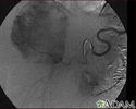 Hemangioma - angiograma