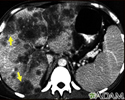 Câncer Hepatocelular, Tomografia Computadorizada