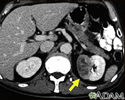 Tumor nos rins - tomografia computadorizada