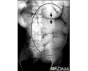 Íleo - raio X de distensão intestinal