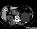 Cisto renal com cálculos biliares, tomografia computadorizada