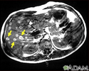 Melanoma no fígado - Ressonância magnética