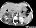 Neuroblastoma no fígado – tomografia computadorizada
