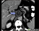 Câncer pancreático, tomografia computadorizada