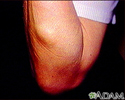 Lipoma - braços