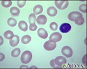 Anemia megaloblástica - visualização dos glóbulos vermelhos