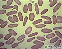Glóbulos vermelhos, eliptocitose