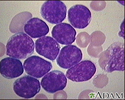 Leucemia linfocítica aguda - fotomicrografia