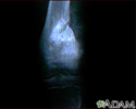 Sarcoma osteogênico - Raio x