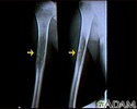 Sarcoma de Ewing - Raio x