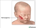 Excisão de hemangioma - série
