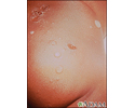 Impetigo, bulbos nas nádegas