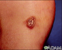 Sarcoma de Kaposi - lesão no pé