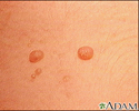 Molusco contagioso - imagem aproximada