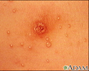 Molusco contagioso - imagem aproximada do tórax