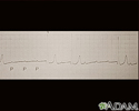 Obstrução atrioventricular, traçado do ECG