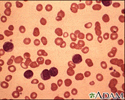 Leucemia linfocítica crônica - visualização microscópica