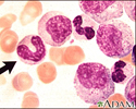 Leucemia mielocítica crônica - visualização microscópica