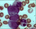 Leucemia mielocítica crônica