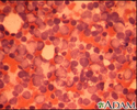 Leucemia mielocítica crônica