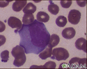 Mononucleose infecciosa nº 3