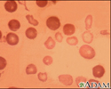 Talassemia maior