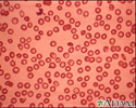 Talassemia menor