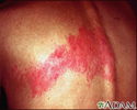 Herpes-zóster (cobreiro) nas costas