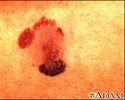 Câncer de pele, melanoma maligno
