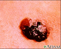 Câncer de pele, melanoma multicolorido saliente