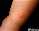 Tinha, tinea corporis na perna de uma criança