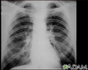 Pneumoconiose dos mineiros de carvão - estágio II