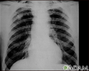 Pneumoconiose dos mineiros de carvão - estágio II nº 2