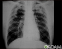 Pneumoconiose dos mineiros de carvão, complicada