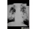 Pneumoconiose dos mineiros de carvão, complicada nº 2