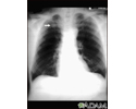 Nódulo pulmonar - raio X de vista frontal