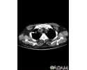 Nódulo pulmonar, solitário - Tomomografia computadorizada (TC)