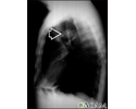 Massa pulmonar - raio X do tórax de vista lateral