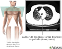 Câncer nos brônquios - tomografia computadorizada (TC)