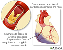 Infarto agudo do miocárdio