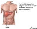 Hepatite agressiva