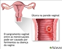 sangramento entre menstruações
