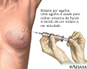 Biópsia de mama por agulha