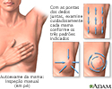 Autoexame da mama