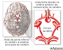 Aneurrisma cerebral